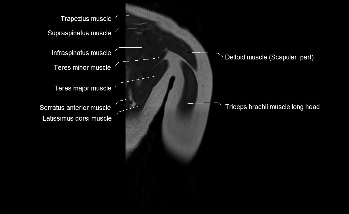 MRI upper arm (humerus ) coronal cross sectional anatomy image 28.webp